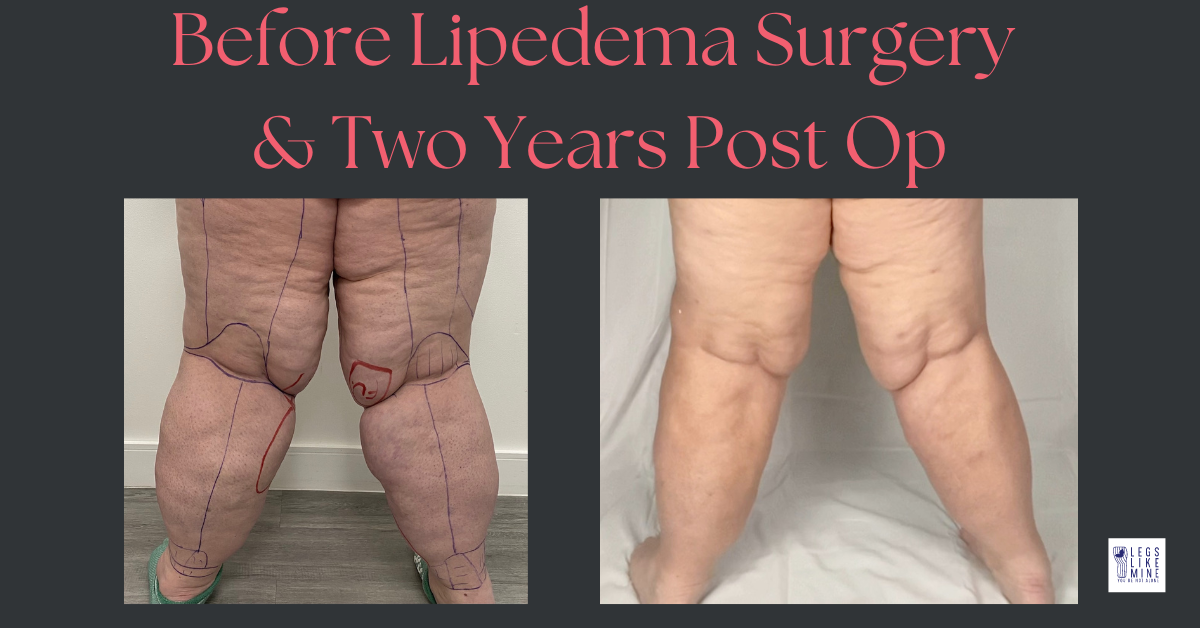 Before lipedema surgery & to years post op.