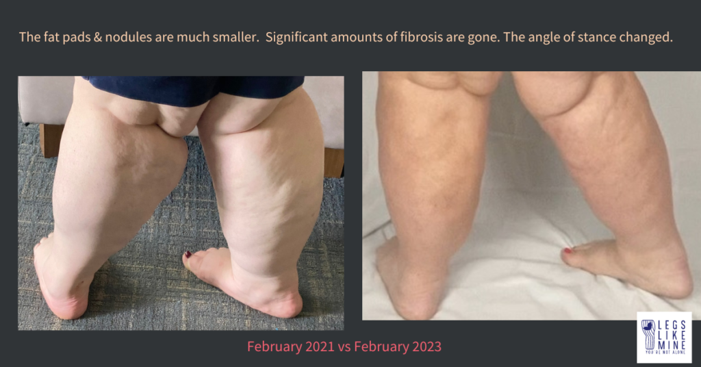 The fat pads & nodules are much smaller. Significant amounts of fibrosis are gone. The way I stand changed.