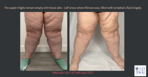 The upper thighs remain empty with loose skin. Calf areas where fibrosis was, filled will lymphatic fluid largely.