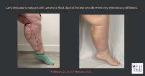 Larry the lump is replaced with lymphatic fluid. Back of the legs are soft where they were dense and fibrotic.